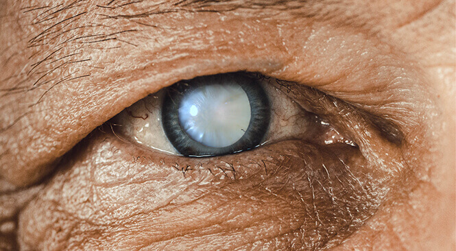 cataratas en los ojos