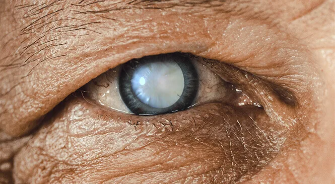 cataratas en los ojos