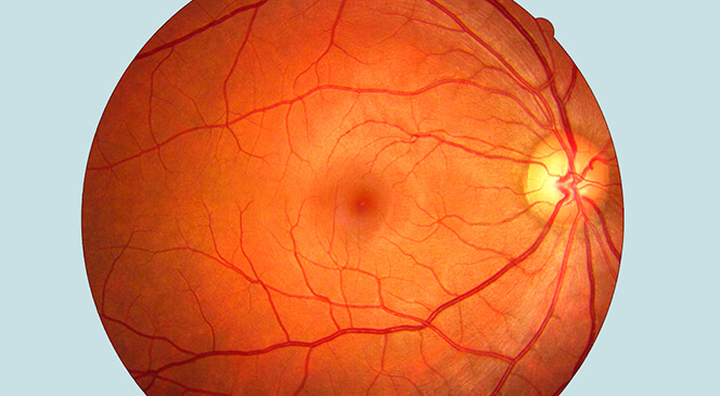retina inflamada