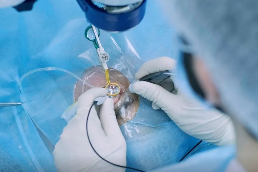 AGUJERO MACULAR - TRATAMIENTO