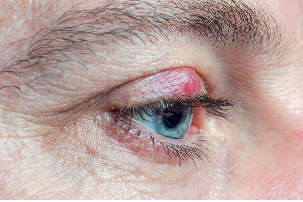 CAHALAZION. BENEFICIOS CIRUGÍA