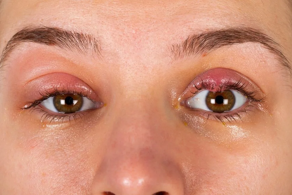 CHALAZION TECNICA