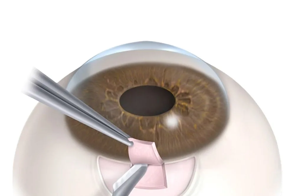 CIRUGÍA GLAUCOMA- Trabeculectomía