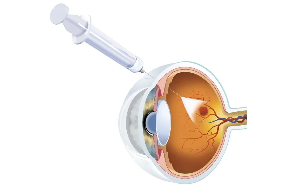 Inyección Subconjuntival
