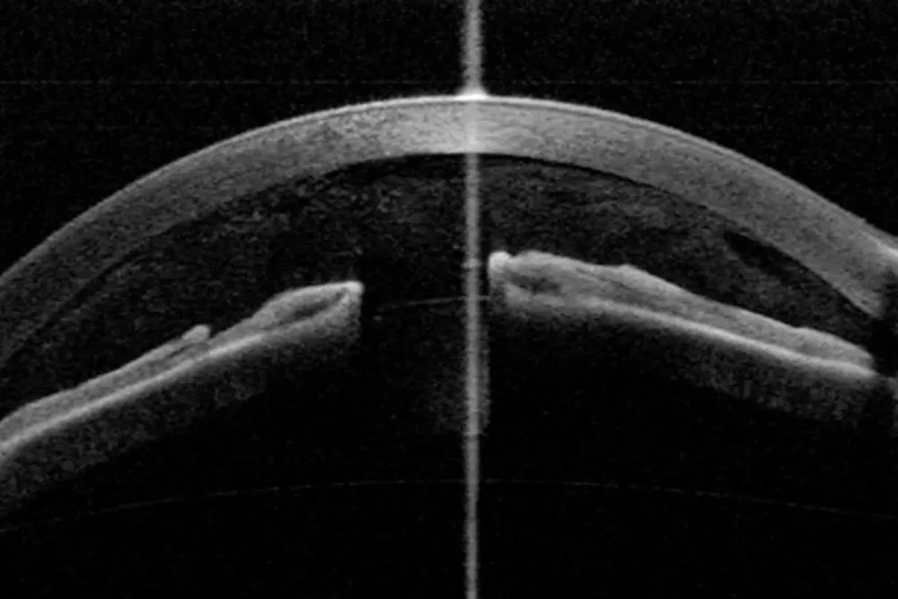 OCT de Segmento Anterior - Tomografía de Coherencia Óptica