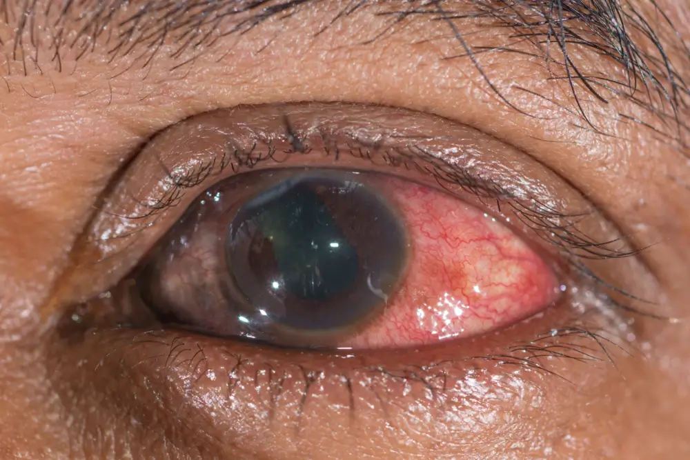 RETINA CAUSAS