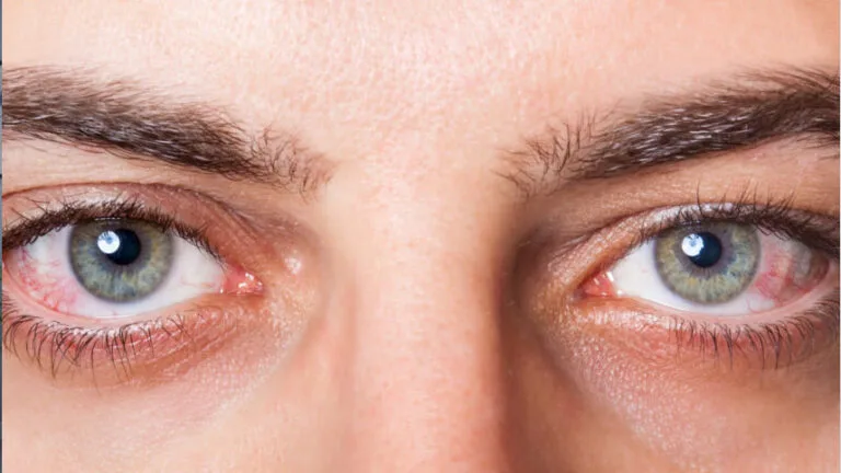 ojos con retinopatía