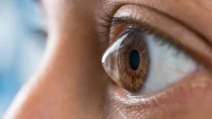 crosslinking corneal queratocono ojo