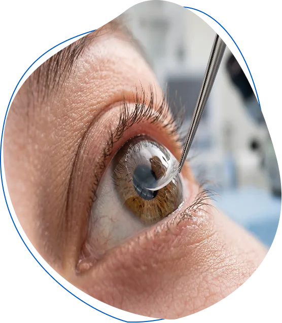 Cirugia-de-cornea