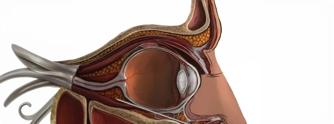 Inyección Transeptal