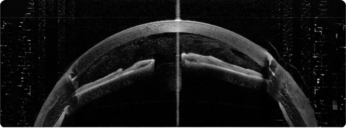 OCT de Segmento Anterior - Tomografía de Coherencia Óptica