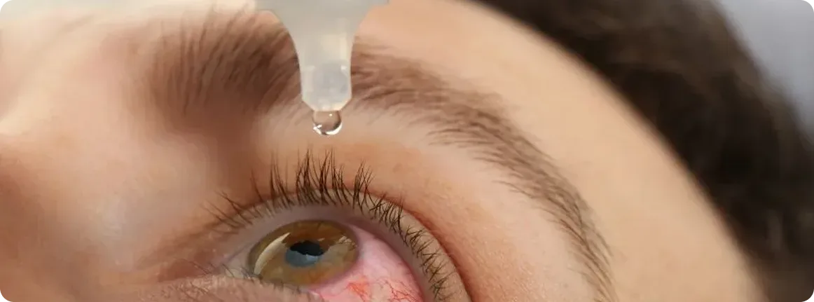 tratamiento de la queratitis en Lima