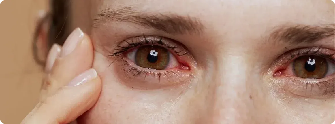causas de uveitis