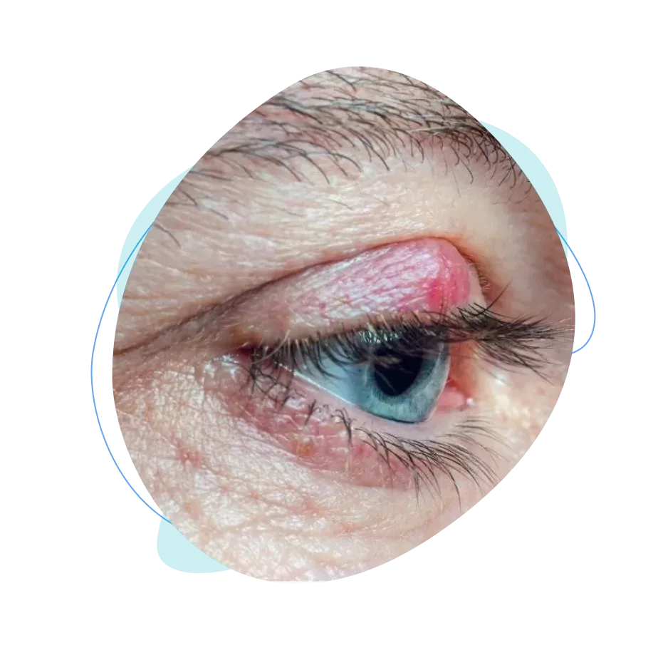 beneficios de operarse de chalazion