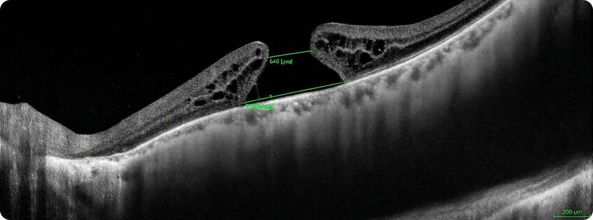Causas agujero macular