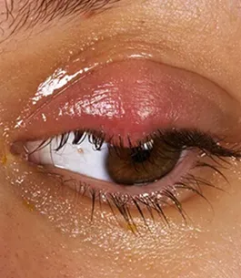 cirugias de chalazion