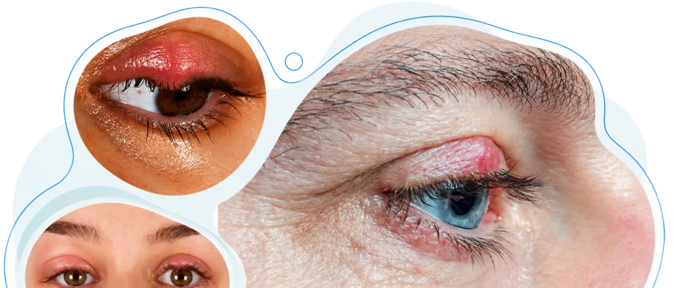 cirugía_chalazion