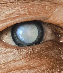 cataratas para operarse