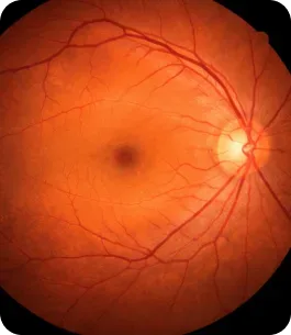 operación de retina