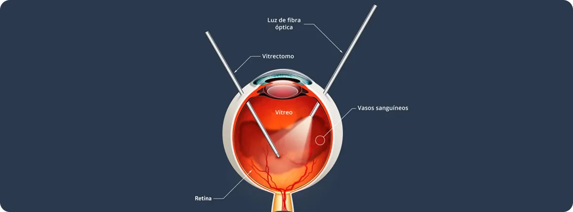 Tratamiento desprendimiento de retina