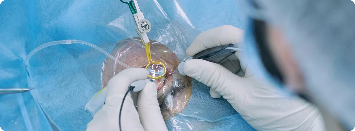 Tratamiento agujero macular