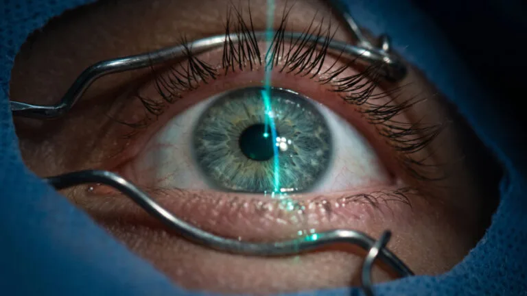 Primer plano de un ojo durante una cirugía LASIK, con blefarostato y haz de láser guiando el procedimiento