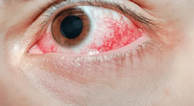 uveitis caso